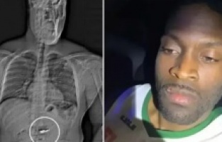 ABD’de Şoke Eden Soygun! 770 Bin Dolarlık Küpeleri Yuttu, Polis Röntgende Tespit Etti