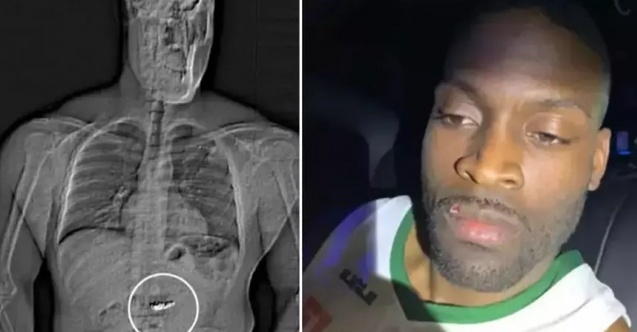 ABD’de Şoke Eden Soygun! 770 Bin Dolarlık Küpeleri Yuttu, Polis Röntgende Tespit Etti